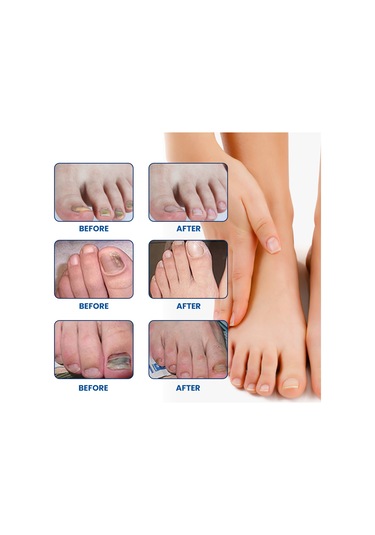 Folinda Xımonth Tırnak Mantarı Tamir Yama 32 Adet - Glyserin, Allantoin Ve Çay Ağacı Yağı İçeren 2.8x2.3cm Boyutlu