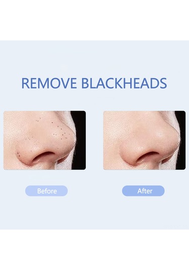 Youtek "ultrasonik Cilt Temizleme Cihazı - Siyah Nokta Kırma, Besin Aktarımı Ve Cilt Sıkılaştırma"