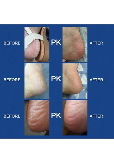 Elektrikli Rulo Kafa İle Taşınabilir Ayak Törpüsü Mavi