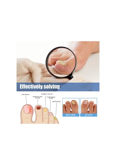 Singree 32 Adet Tırnak Mantar İyileştirici Yama - 2.8x2.3cm, Gliserin & Çay Ağacı Yağı İçeren Tırnak Onarım Yama Seti