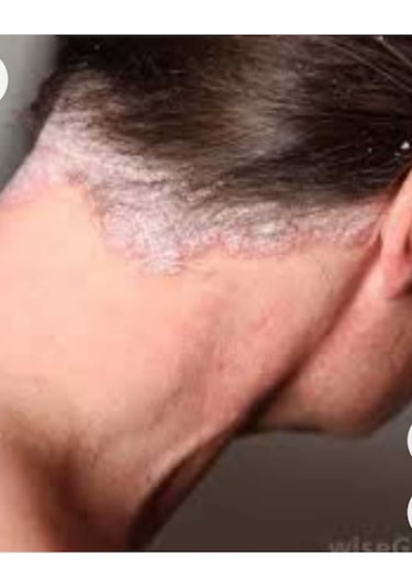 Cilton E Derm Özel Bakim Kremi 50 Ml