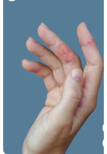 Cilton E Derm Özel Bakim Kremi 50 Ml