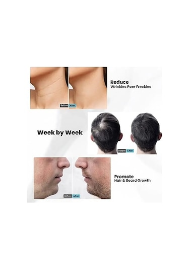 Novahub 540 Derma Rulo Mikro İğneler Saç Büyüme Yüz Masajı Cilt Bakımı Mavi Mavi