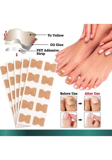 Yifomall 50 Adet Oýnaxan Tırnak Tamiri Seti - Ayak Tırnağı Yumuşatıcı Bandajı, Profesyonel Tırnak Düzeltme Yapistırıcısı