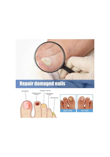 Yifomall 32 Adet Onyxomykoz Ve İçine Giren Tırnak Tamir Bandı - Su Geçirmez, Nefes Alır, Tırnak Büyüme Açısını Düzeltir Bakım Bandı