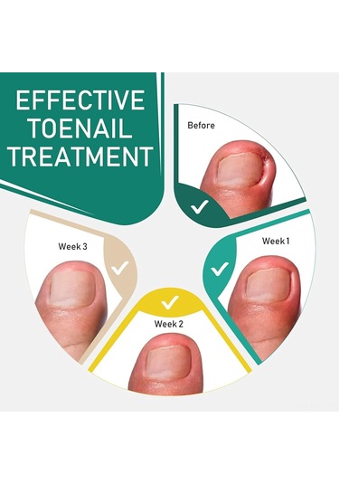Yifomall 50 Adet Oýnaxan Tırnak Tamiri Seti - Ayak Tırnağı Yumuşatıcı Bandajı, Profesyonel Tırnak Düzeltme Yapistırıcısı