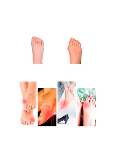 Akestoria Med Ayarlanabilir Cırtlı Baş Parmak Kemik Sönger Düzeltici Fc-053 Standart