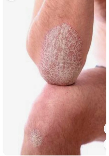 Cilton E Derm Özel Bakim Kremi 50 Ml