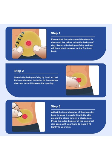 10pcs Ostomi Bariyer Halkaları-dış Çap: 2" 50mm 2mm Kalınlık Tüm Çanta Tipleri Ve Markalarla Uyumlu