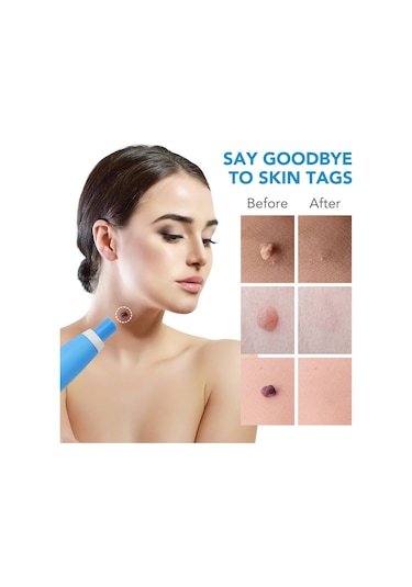 Vkemall Hızlı Ve Etkili Siğil Ve Et Beni Temizleme Seti - 2 Başlık + 40 Lastik Bant 112 Karakter