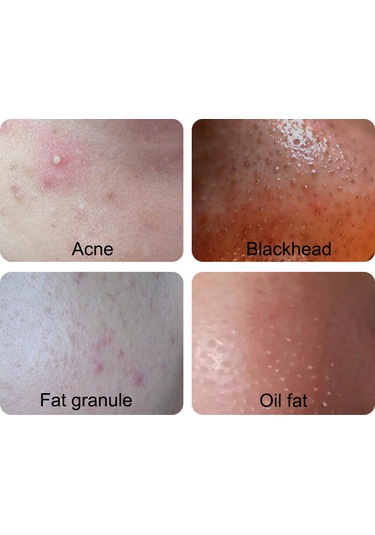 Vkemall Siyah Nokta Temizleme Seti: Paslanmaz Çelik, Çeşitli Renklerde Çanta, 2 Veya 3 Parça Seçenekli