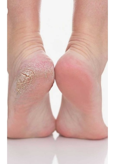 Cilton E Derm Özel Bakim Kremi 50 Ml