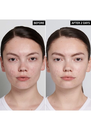 The Inkey List Succinic Acid Acne Treatment 15 ML