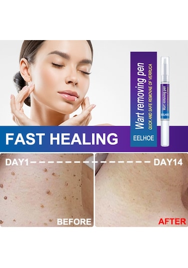 Cilt Etiketi Sökücü Benlere Karşı Tıbbi Ağrısız Hızlı Kaldırma Genital Siğil Akne Leke Tedavisi Papillomlar Düz Siğil Güzellik Sağlık