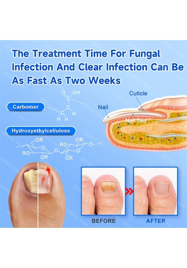 Xurunkeji Adet Mantarlı Tırnak Lazer Cihazı Onarımı Tırnak Tedavisi Mantar Enfeksiyonu Paronişi Onikomikoz Batık Ayak Tırnağı