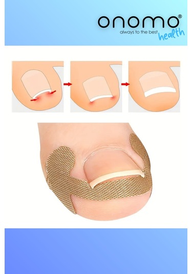 Batık Tırnak Düzeltme Bandı 20 Adet