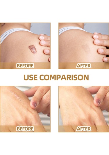 Hangfox 60 Adet Silikon Gizleme Yama Seti - Doğal Görünüm, Nefes Alıcı - Yara Izleri, Doğuş Lekeleri Ve Benekler İçin Uygun