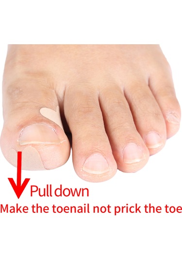 Moveevo Kelebek Şeklinde Batık Tırnak Ters Germe Düzeltme Yaması 36 Yama