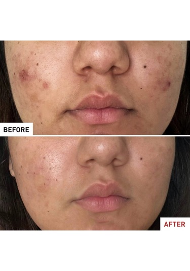 Erborian Centella Acné Care - Yatıştırıcı Sıvı 30 Ml