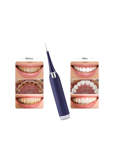 Wezone Evde Kullanan Elektrikli Diş Taşı Temizleyici - Ipx7 Su Geçirmezli, Mavi, 2 Fırça + 2 Uçlu Başlık