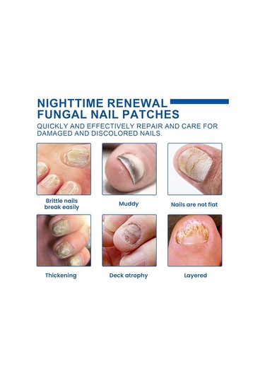 Yifomall 32 Adet Onyxomykoz Ve İçine Giren Tırnak Tamir Bandı - Su Geçirmez, Nefes Alır, Tırnak Büyüme Açısını Düzeltir Bakım Bandı