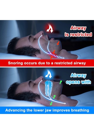 Ayarlanabilir Anti Horlama Ağız Koruyucusu Anti-horlama Ağızlık Uyku Cihazları Bruksizm Horlama Stoper Uykuyu Geliştirin Ağızlık Fildişi