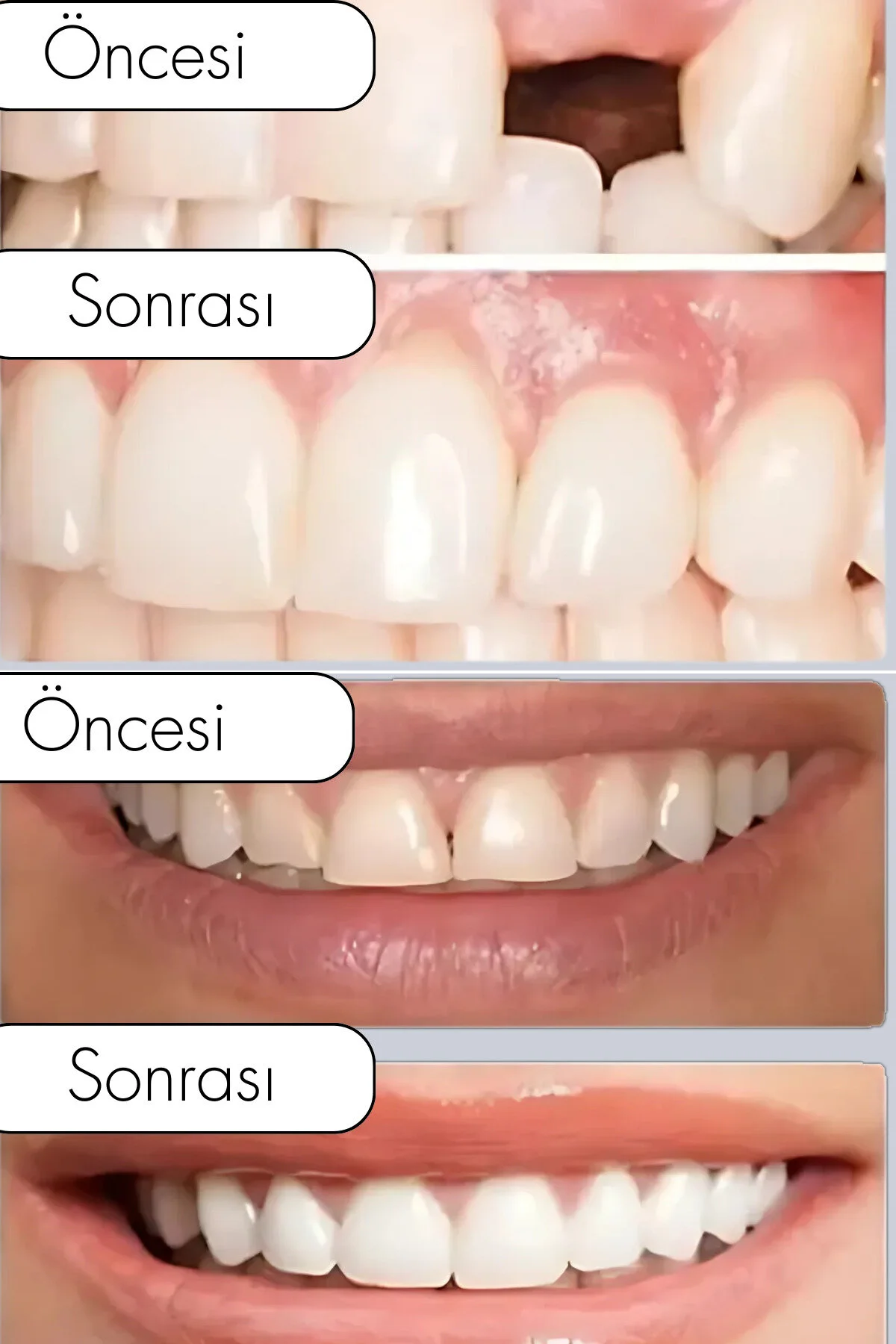 Moldable Diş Onarım Kiti