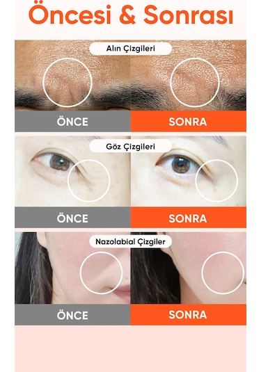 Retinol Ve Pdrn Mikro İğneli Göz Altı Ve Nazolabial Çizgi Reti-rn Microcone Patch Slim 6 Lı