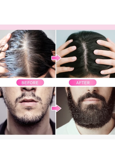 Vkemall Cilt Gençleştirme İğneli Rulo - Kırışıklık Ve İz Giderici Mikro İğne Terapisi 540 İğne, 0.3mm/1.0mm/3.0mm