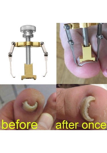 Qingmipy Altıparmak Tırnağı Düzeltme Aracı - İçbükey Tırnak Sorunu Çözücü - Paslanmaz Çelik Altın