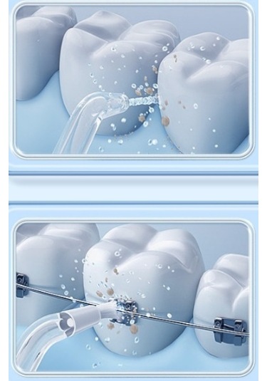 Lichen Diş Taşlarını Çıkarmak İçin Elektrikli Taşınabilir Su İpi