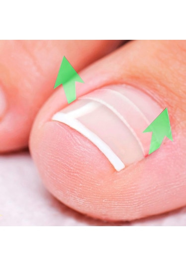 Moveevo Paronişi Düzeltme Aleti Batık Tırnaklar Ve Kıvırcık Tırnaklar Düzeltme Aleti Seti 24 Yama