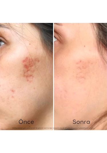 Glana Glikolik Asit Peeling Tonik 125 ML