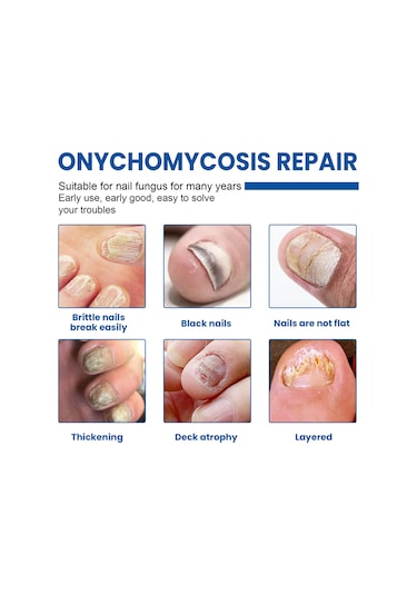 Folinda Xımonth Tırnak Mantarı Tamir Yama 32 Adet - Glyserin, Allantoin Ve Çay Ağacı Yağı İçeren 2.8x2.3cm Boyutlu