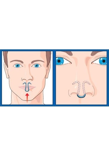 ClipAir Horlama Önleyici Burun Aparatı