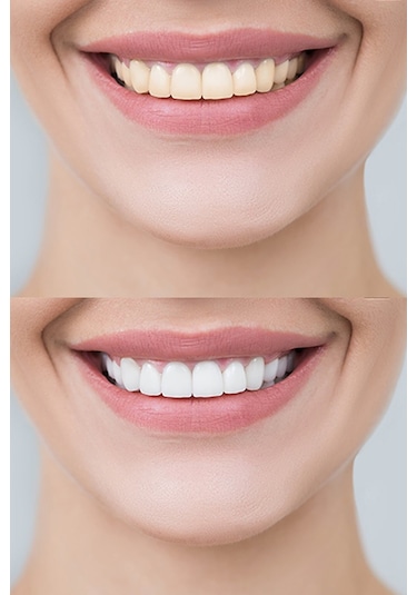 Luis Bien Diş Beyazlatma Seti 2'li