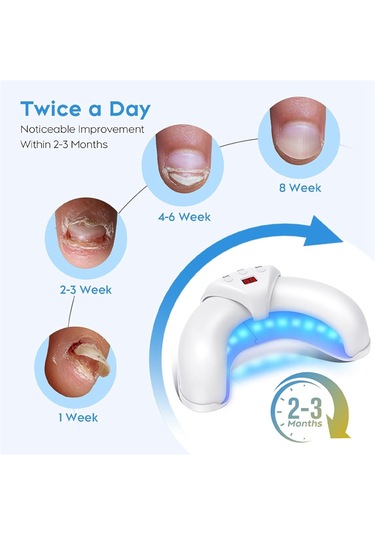 Xurunkeji Adet Mantarlı Tırnak Lazer Cihazı Onarımı Tırnak Tedavisi Mantar Enfeksiyonu Paronişi Onikomikoz Batık Ayak Tırnağı