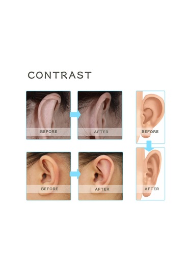 Yaleker Wiieey Bebek Kulak Düzeltme Yapışkanı: Yumuşak Silikon, Nefes Alabilir, Su Geçirmez, Güvenli Ve Rahat Kullanım