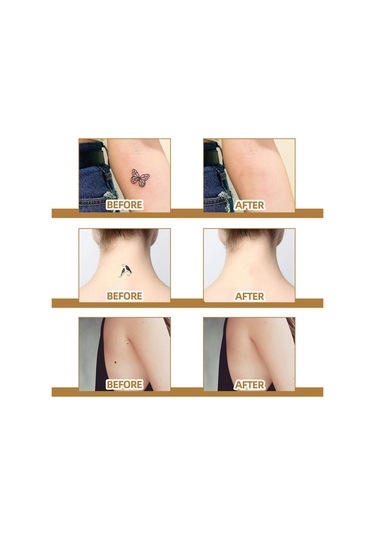 Hangfox 60 Adet Silikon Gizleme Yama Seti - Doğal Görünüm, Nefes Alıcı - Yara Izleri, Doğuş Lekeleri Ve Benekler İçin Uygun