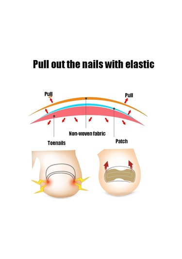 10 Adet Tutkalsız Ortopedik Tırnak Ayak Düzeltici Beyaz Alt