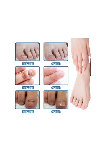 Yifomall 32 Adet Onyxomykoz Ve İçine Giren Tırnak Tamir Bandı - Su Geçirmez, Nefes Alır, Tırnak Büyüme Açısını Düzeltir Bakım Bandı