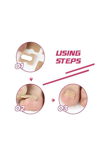 Wezone Nefes Alabilen Tırnak Düzeltme Yapışkanları - 10 Adet 100 Yapışkan, Batık Tırnak Tedavisi İçin Pratik Çözüm