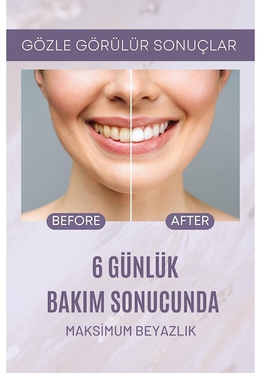 Billion Dollar Smile Top Up Kit Diş Beyazlatıcı Set