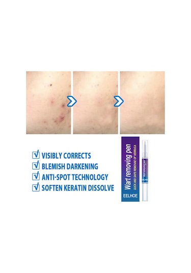 Cilt Etiketi Sökücü Benlere Karşı Tıbbi Ağrısız Hızlı Kaldırma Genital Siğil Akne Leke Tedavisi Papillomlar Düz Siğil Güzellik Sağlık