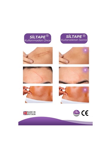 Advancis Medical UK Siltape Soft Silikon Yara İzi Dikiş İzi Sezaryen Yanık Estetik Bant 4 CM x 1500 CM