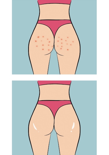 Skin Sensual Buttoks Buttne Vücut Maskesi | Vücut Sivilceleri ve Pürüzlere Karşı | 2 Parça