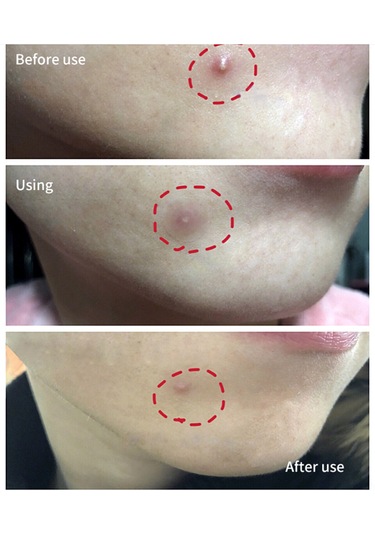 Youtek Breylee Görünmez Sivilce Yama - 22 Adet 12mm+10mm - Doğal Görünüm Sağlar