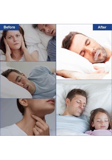 Vkemall Elaımeı Anti Horlama Uyku Bantları Tek Kullanımlık Ağız Bantları Bant Ağız Kurul Beyaz