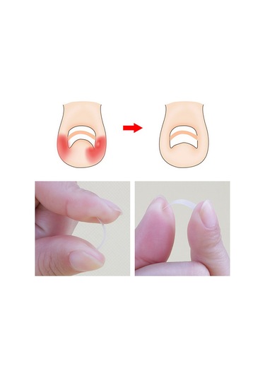 Moveevo Paronişi Düzeltme Aleti Batık Tırnaklar Ve Kıvırcık Tırnaklar Düzeltme Aleti Seti 24 Yama