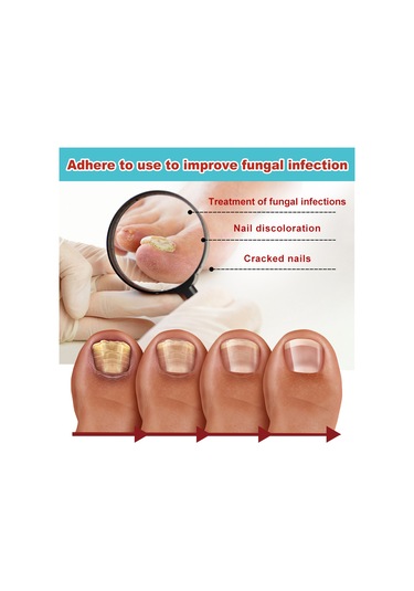 Vkemall South Moon Gece Tırnak Yaması - Mantar, Yumuşak Ve Hasarlı Tırnaklar İçin Onarıcı Bakım 16 Adet